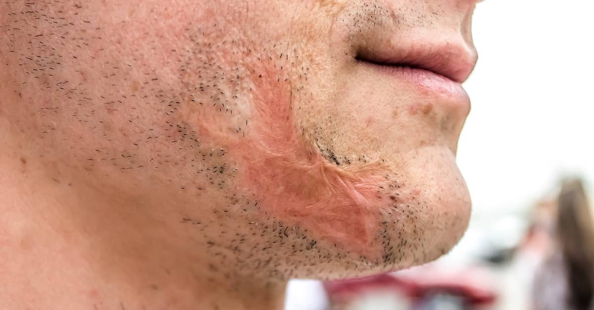 Man with scarring from a burn injury on his face | Burg Simpson