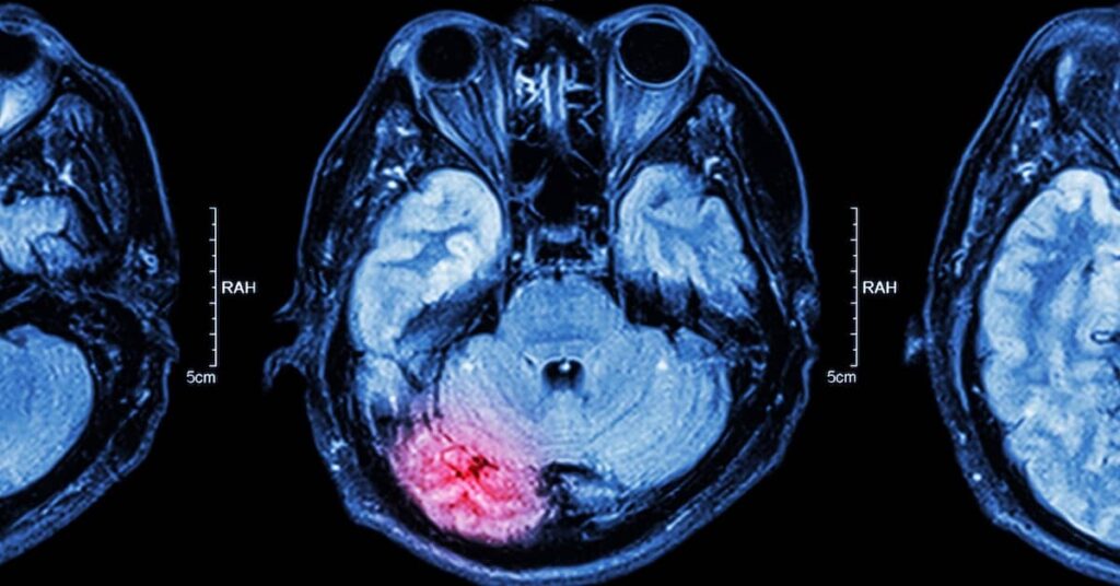 MRI scan of a brain injury | Burg Simpson